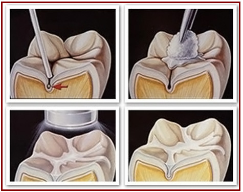 dental sealant