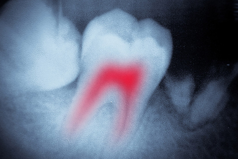 Endodontic treatment - root canal