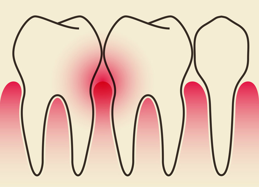 periodontal disease