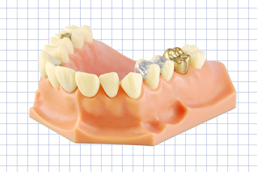 restoration - dental bridges, crowns
